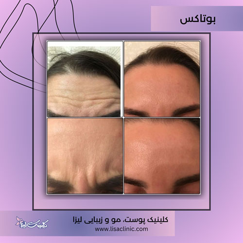 بوتاکس-صورت--کلینیک-لیزا-غرب-تهران-1