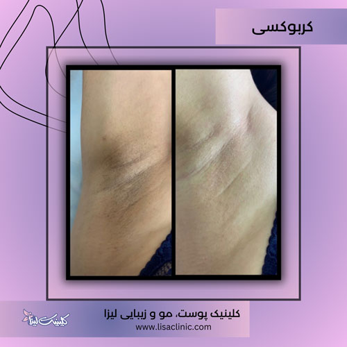 کربوکسی تراپی-زیر بغل-کلینیک-لیزا-غرب-تهران-1