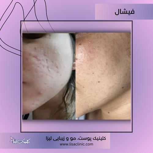 فشیال -صورت-کلینیک-لیزا-غرب-تهران-1