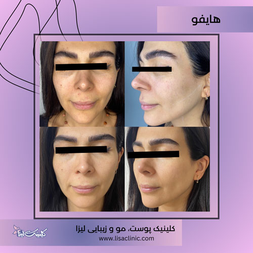 هایفوتراپی-صورت-کلینیک-لیزا-غرب-تهران-1