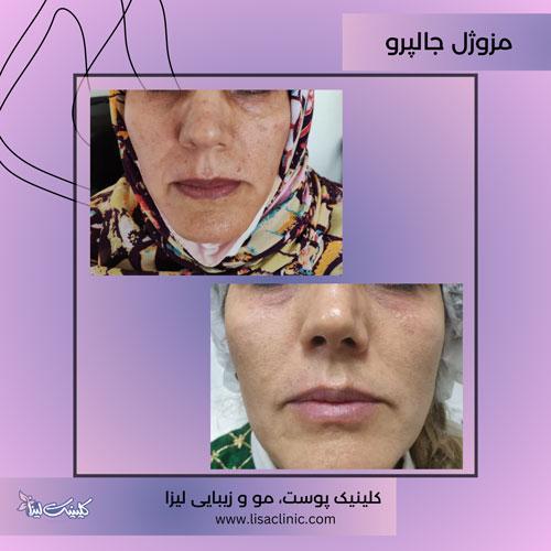 تزریق-مزوژل-جالپرو-صورت-کلینیک-لیزا-غرب-تهران-1