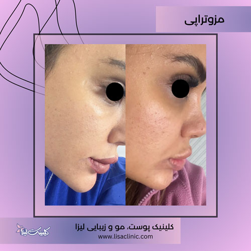 مزوتراپی-صورت-کلینیک-لیزا-غرب-تهران-1