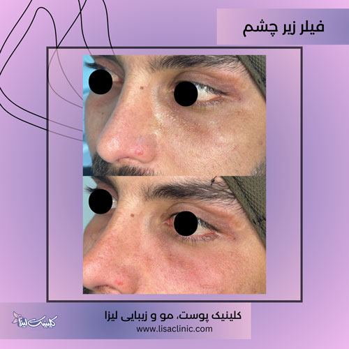 تزریق-فیلر-زیر چشم-کلینیک-لیزا-غرب-تهران-1