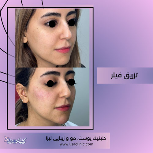 تزریق-فیلر-گونه-کلینیک-لیزا-غرب-تهران-1