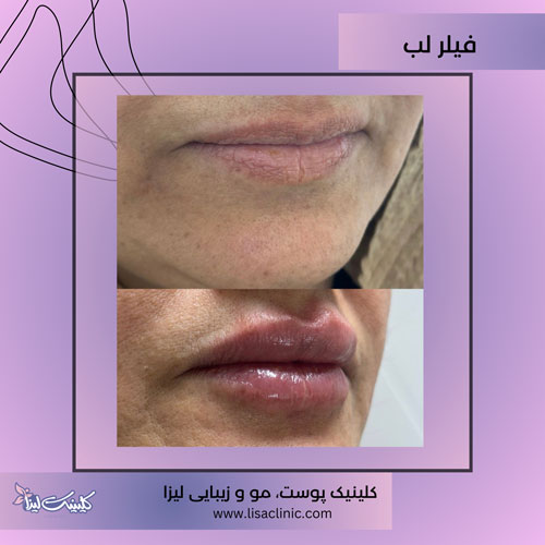 تزریق-فیلر-لب-کلینیک-لیزا-غرب-تهران-1