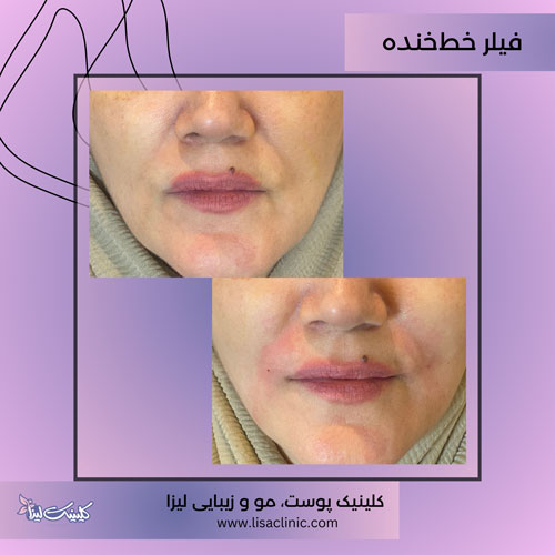 تزریق فیلر خط خنده در بلوار فردوس غرب تهران-کلینیک لیزا تهران