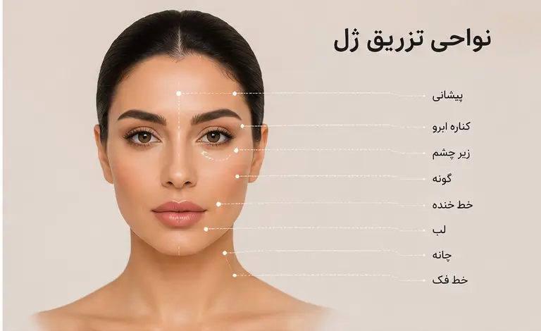 نواحی تزریق ژل صورت شامل لب گونه خط خنده و زیر چشم